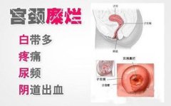 轻度宫颈糜烂的病因 轻度宫颈糜烂的3个症状
